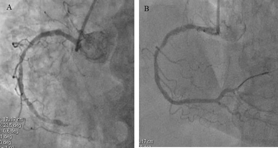 Figura 1: la coronarografia ha mostrato una malattia della coronaria  destra trattata con angioplastica ed impianto di stent medicato